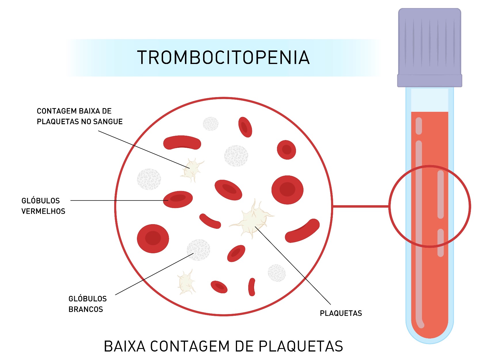 Trombocitopenia